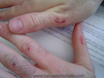 ouch-hands.jpg